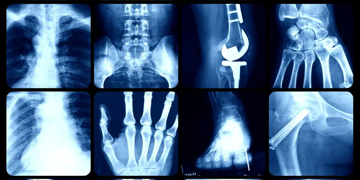 digital x ray a complete guide for patients