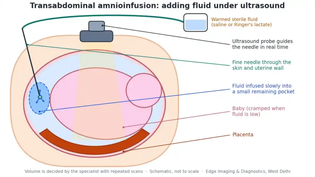 Transabdominal amnioinfusion diagram showing an ultrasound-guided needle infusing warmed sterile fluid into a small amniotic fluid pocket in oligohydramnios