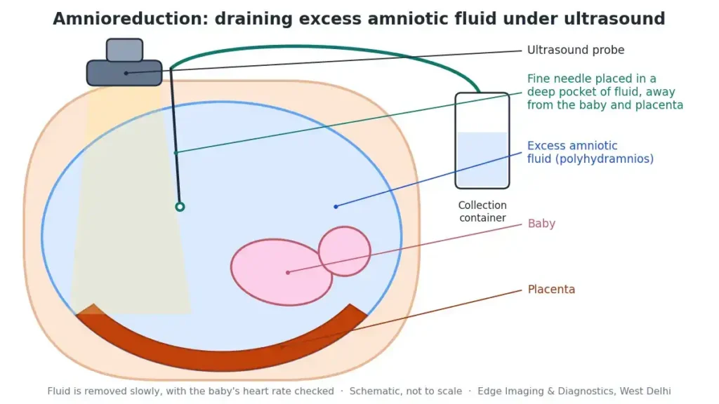 Amnioreduction diagram showing an ultrasound-guided needle draining excess amniotic fluid (polyhydramnios) into a collection container, away from the baby and placenta