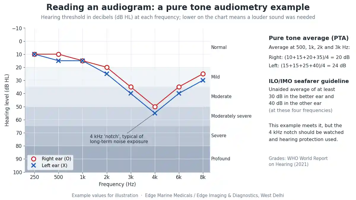 Audiometry test audiogram example showing pure tone audiometry thresholds for the right and left ear, hearing loss grades and a 4 kHz noise notch