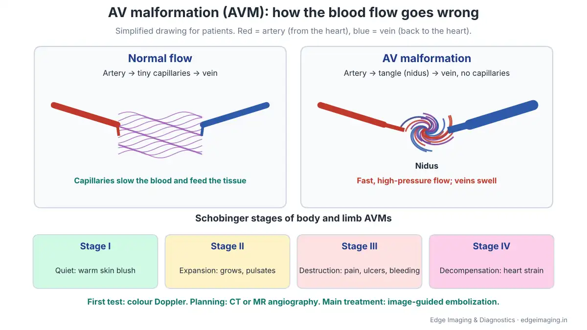 Diagram comparing normal blood flow from artery through capillaries to vein with an AV malformation where arteries connect directly to veins through a tangle called the nidus, with the four Schobinger stages