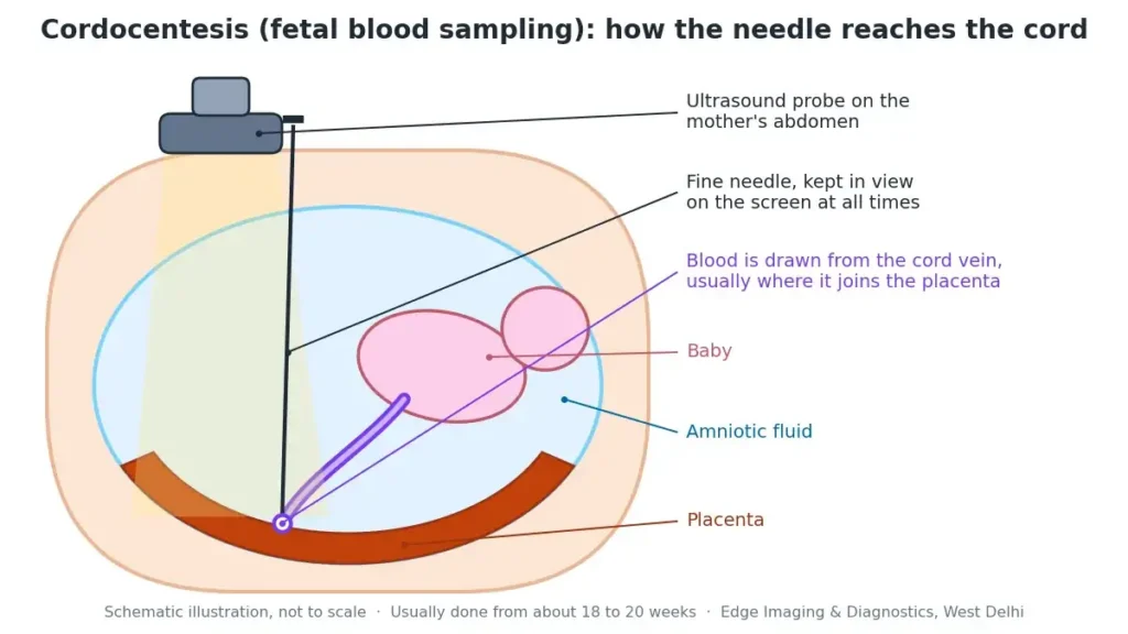Cordocentesis (fetal blood sampling) diagram showing an ultrasound-guided needle reaching the umbilical cord where it joins the placenta
