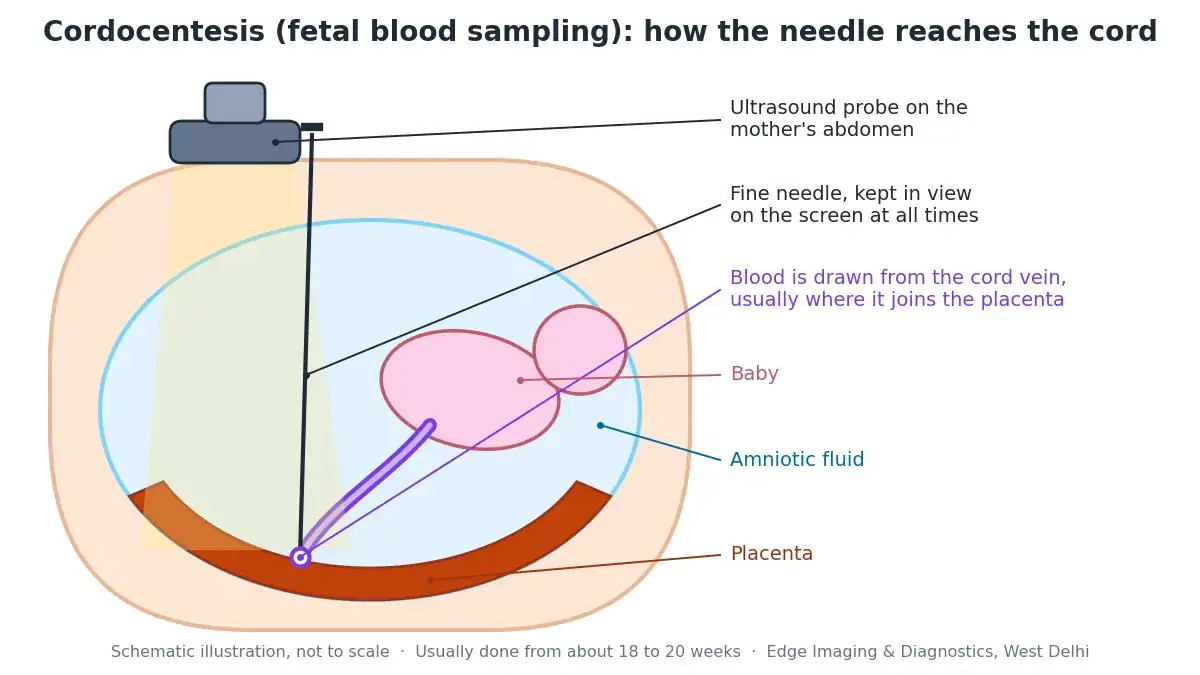 Cordocentesis (fetal blood sampling) diagram showing an ultrasound-guided needle reaching the umbilical cord where it joins the placenta