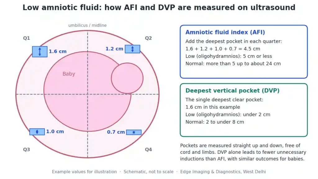 Low amniotic fluid diagram showing how the amniotic fluid index (AFI) and deepest vertical pocket (DVP) are measured on ultrasound to diagnose oligohydramnios