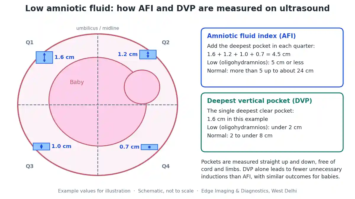 Low amniotic fluid diagram showing how the amniotic fluid index (AFI) and deepest vertical pocket (DVP) are measured on ultrasound to diagnose oligohydramnios