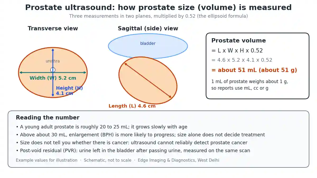 Prostate ultrasound diagram showing how prostate size is measured in transverse and sagittal views and calculated with the ellipsoid formula length x width x height x 0.52