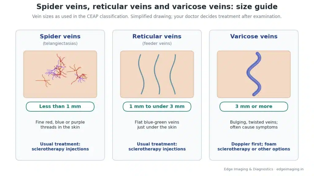 Chart comparing spider veins (less than 1 mm), reticular veins (1 mm to under 3 mm) and varicose veins (3 mm or more) with their usual treatment