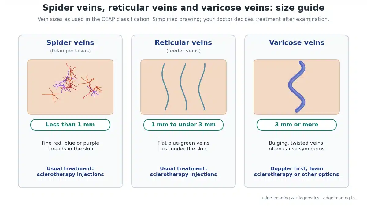 Chart comparing spider veins (less than 1 mm), reticular veins (1 mm to under 3 mm) and varicose veins (3 mm or more) with their usual treatment