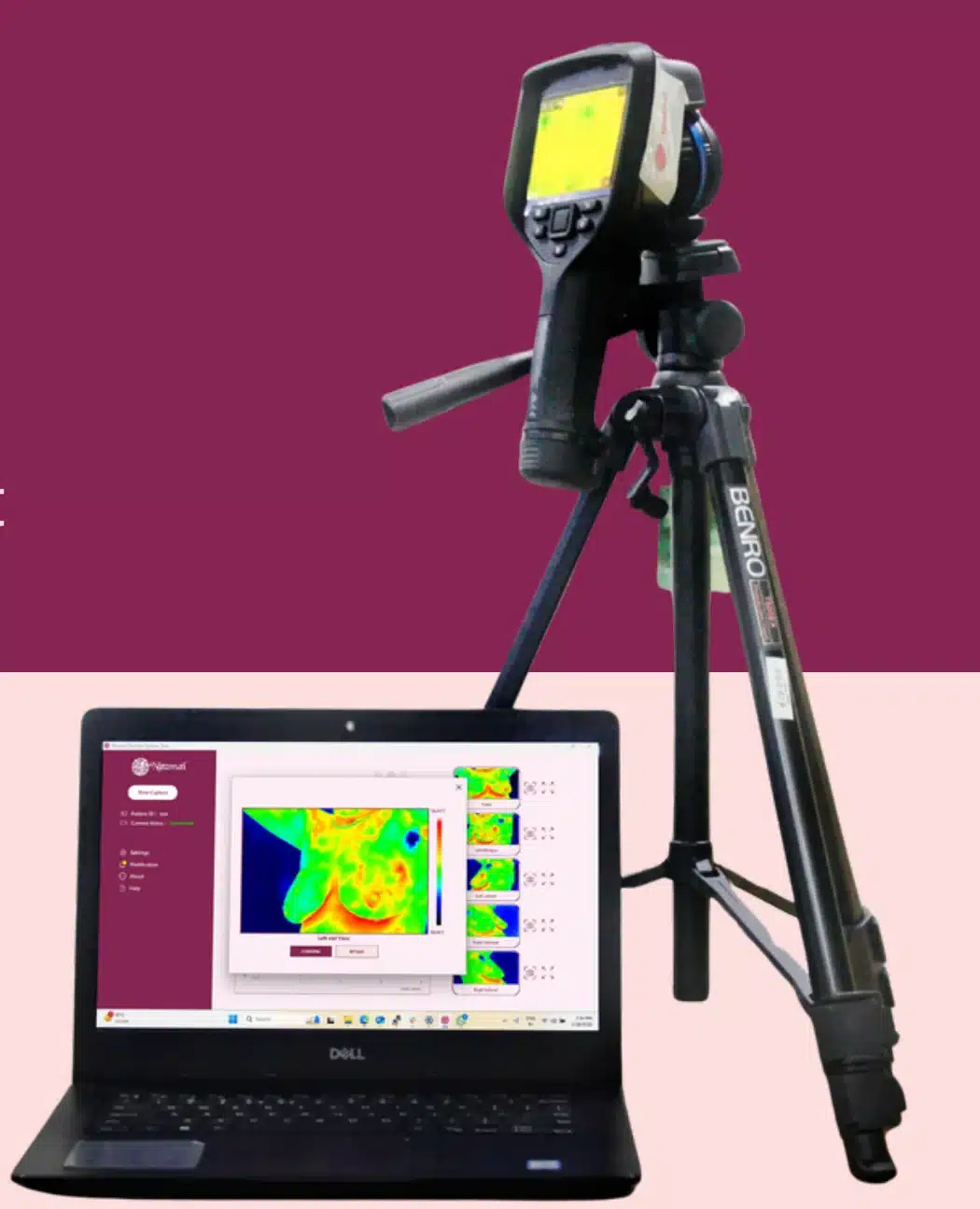 Thermalytix thermal camera on a tripod connected to a laptop showing a breast thermal image