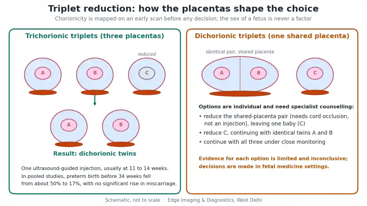 Triplet reduction diagram showing trichorionic triplets reduced to dichorionic twins and the options for dichorionic triplets with a shared-placenta pair
