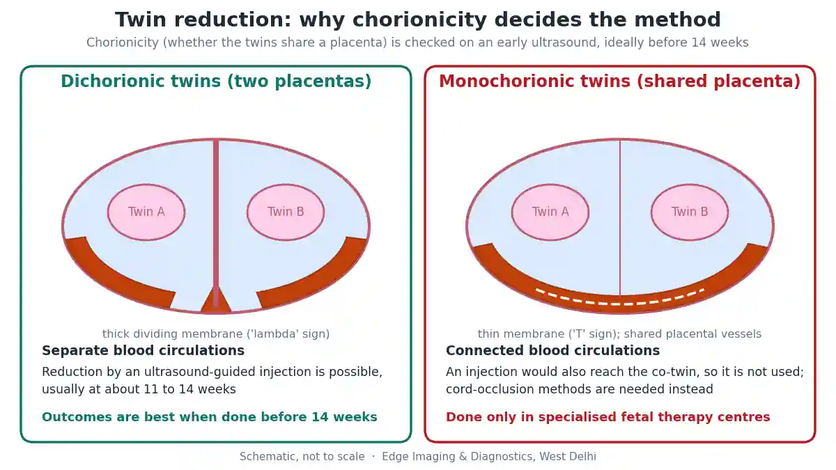 Twin reduction diagram comparing dichorionic twins with two placentas, where twin to singleton reduction by injection is possible, and monochorionic twins with a shared placenta